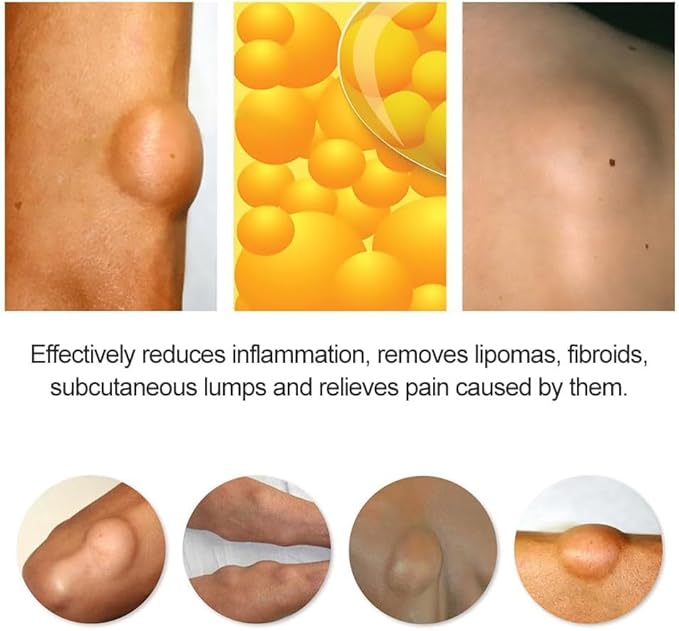 Lipoma Treatment Cream, Herbal , Elimination , Herbal Lumps Removal , Soothing Ointment, 20g