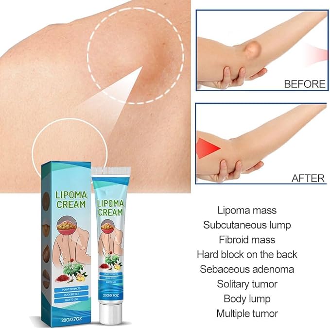 Lipoma Treatment Cream, Herbal , Elimination , Herbal Lumps Removal , Soothing Ointment, 20g